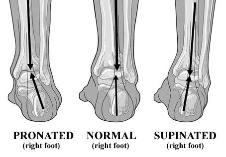 Flat feet and outlet supination